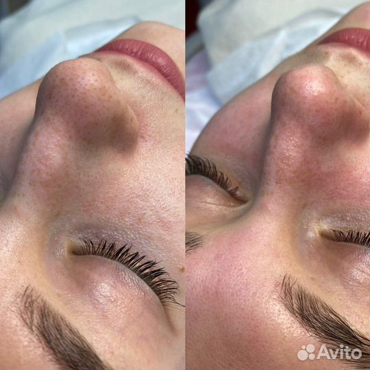 Врач-косметолог: чистка лица, бта, увеличение губ