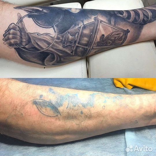 Удаление татуировок