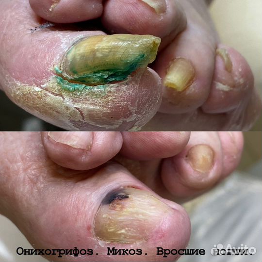 Подолог, педикюр