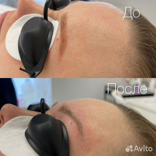 Удаление татуировок