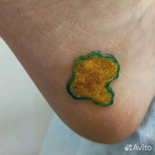 Медицинский педикюр подолог