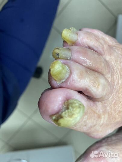 Педикюр пожилым на дому