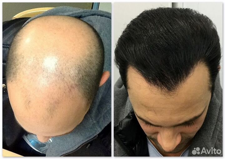 Рост волос без пересадок