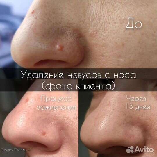 Удaление родинок, папиллом, бородавок