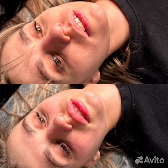 Увеличение губ