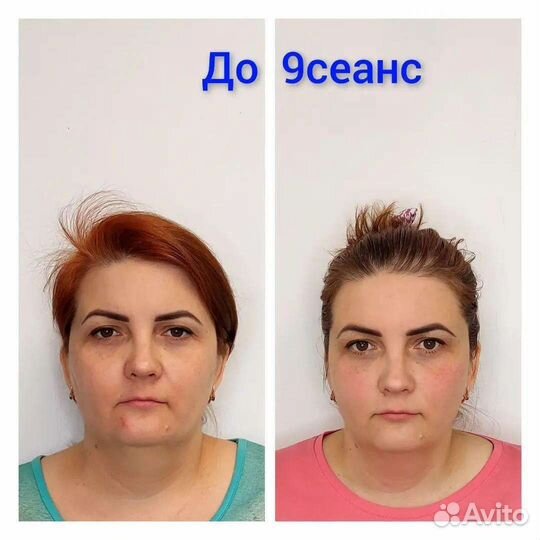 Лифтинг-массаж лица