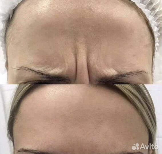 Ботулинотерапия