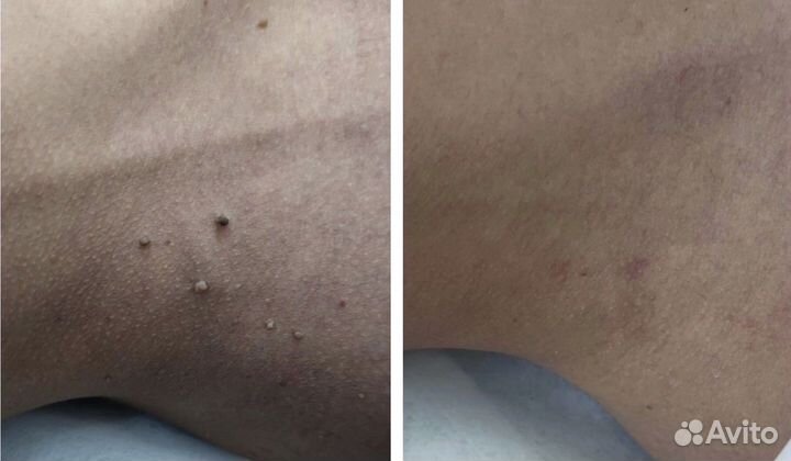 Удаление папиллом, жировиков, бородавок, гемангиом