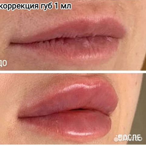 Увеличение губ