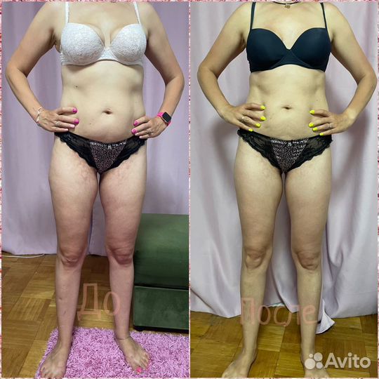 Вакуумно-роликовый массаж starvac