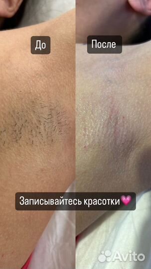 Восковая депиляция