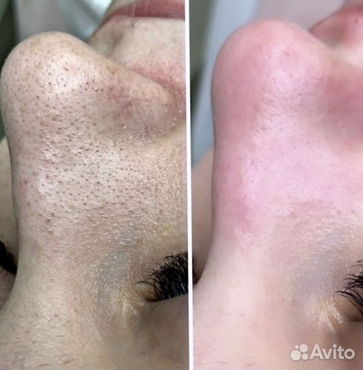 Чистка лица и пилинг