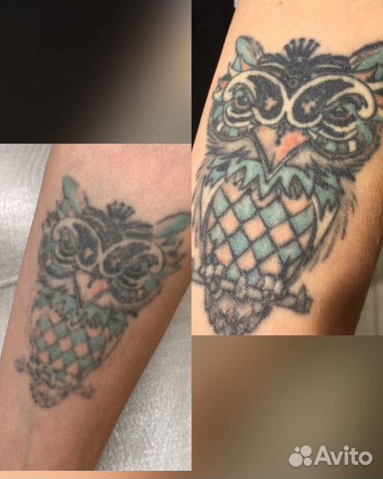 Удаление татуировок