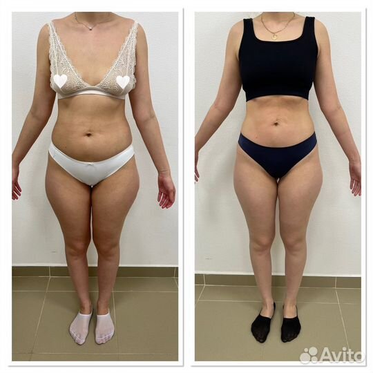 LPG-массаж на аппарате Vortex