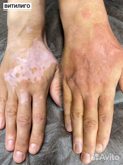 Реконструктивная дермопигментация