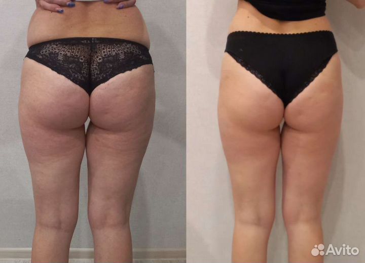 Антицеллюлитный ручной массаж, RFлифтинг,кавитация