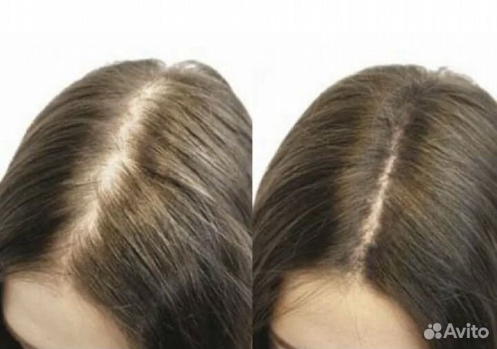 Мезотерапия волос