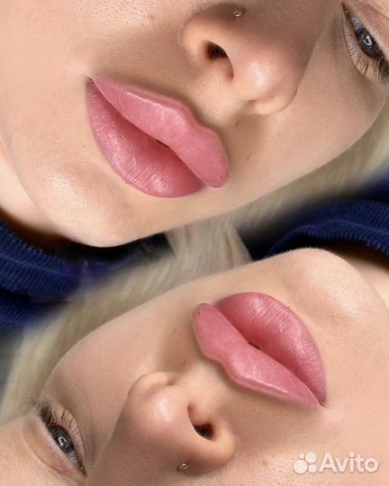 Увеличение губ