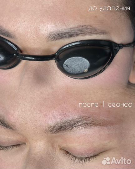 Удаление татуажа бровей/тату