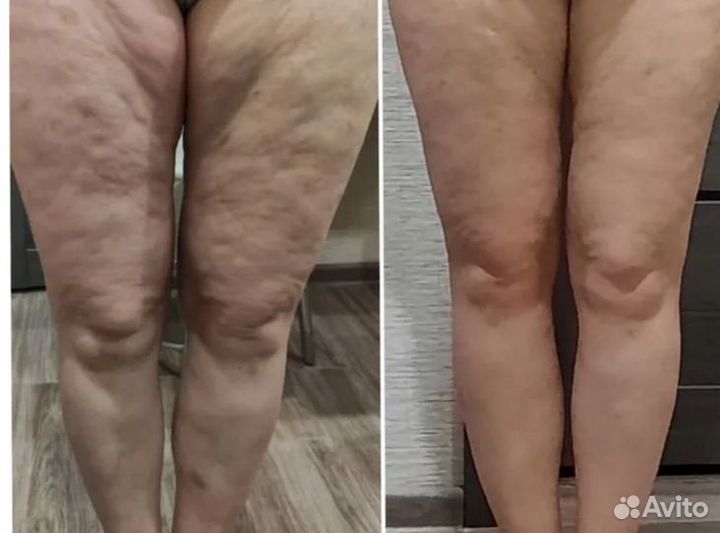 Ищу модель на криолиполиз