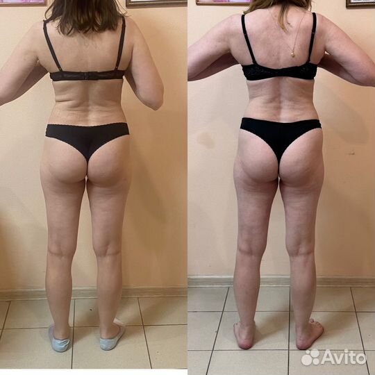 Эндо - Сфера, LPG массаж,вакуумный,корекция фигуры