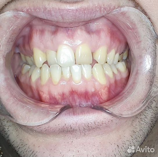 Брекет система