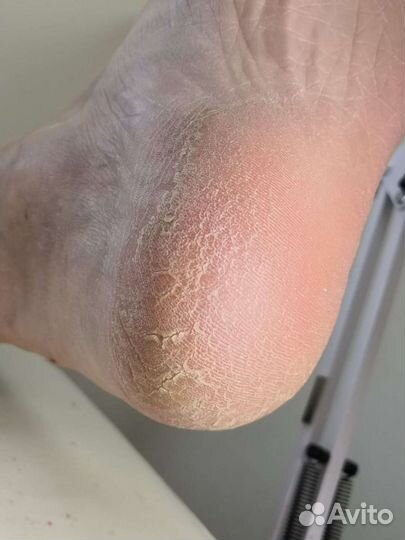 Коррекция наращённых ногтей