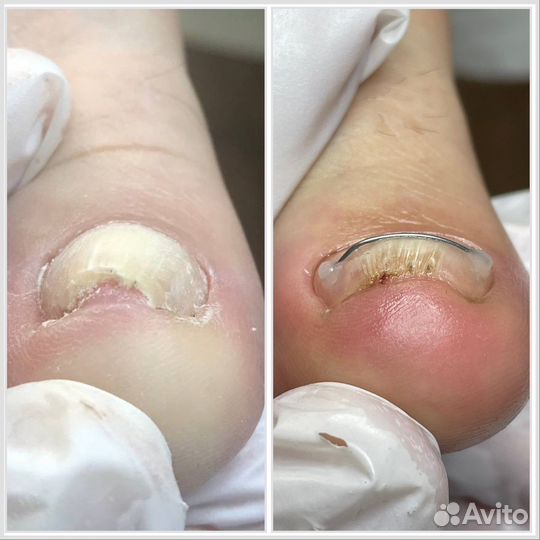 Подологический педикюр