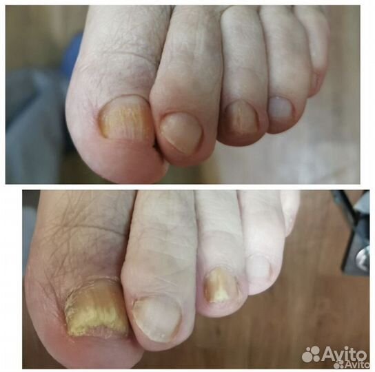 Медицинский педикюр, подолог