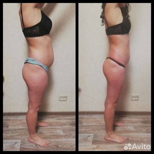 Вакуумный массаж. Кавитация. РФ лифтинг