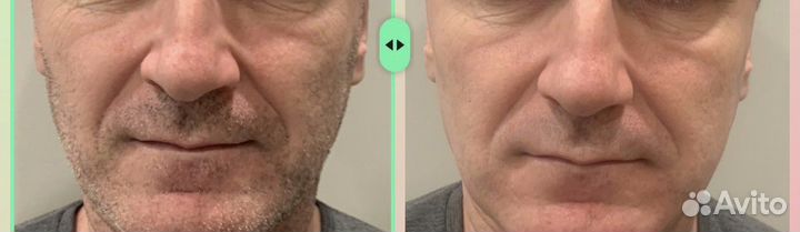 Омоложение Холодной/ Плазмой