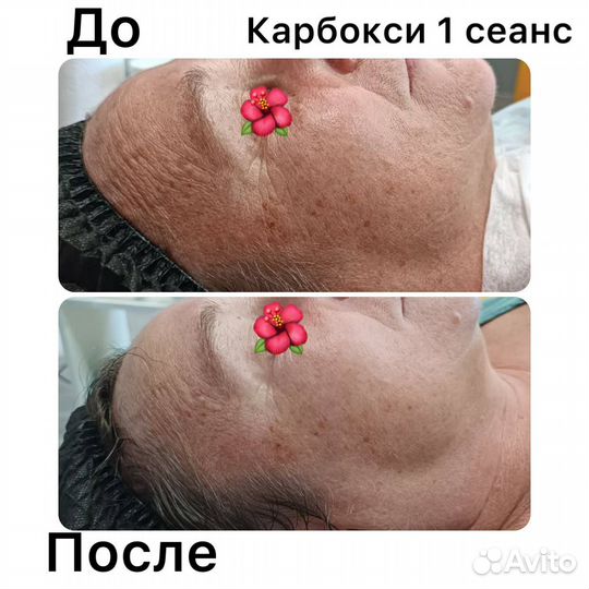 Ищу модель карбокситерапия