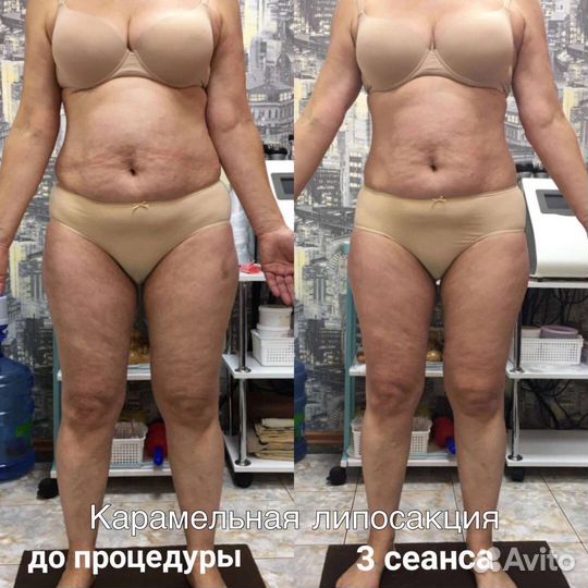 Коррекция фигуры. Липосакция карамельная. Лифтинг