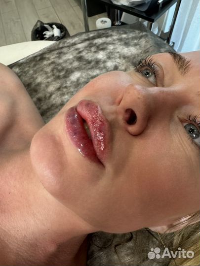 Увеличение губ филлером