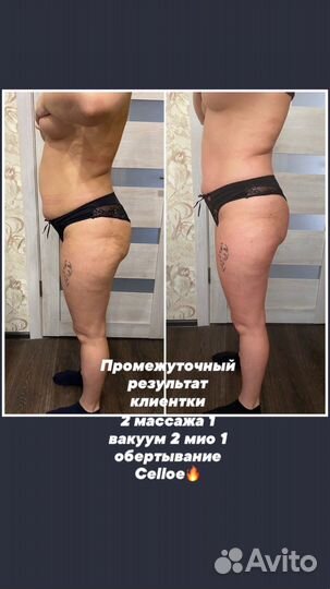 Массаж Аппаратный Ручной медовый