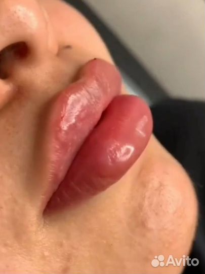 Увеличение губ