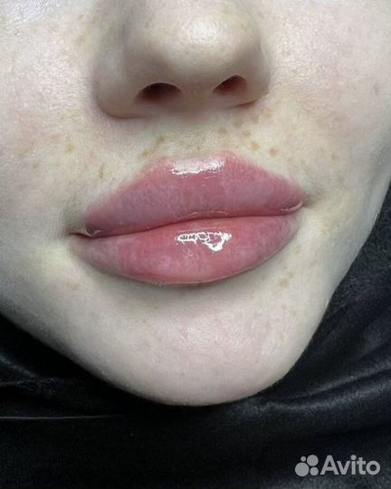 Косметолог, увеличение губ ботокс худое лицо, нити