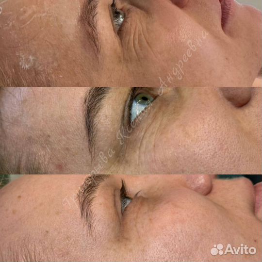 Холодная плазма. Аппаратная косметология. Акне