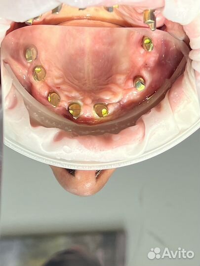 Починка зубных протезов