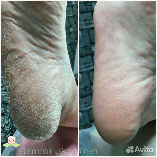 Парафинотерапия