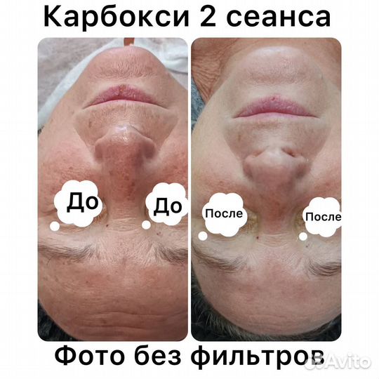 Ищу модель карбокситерапия