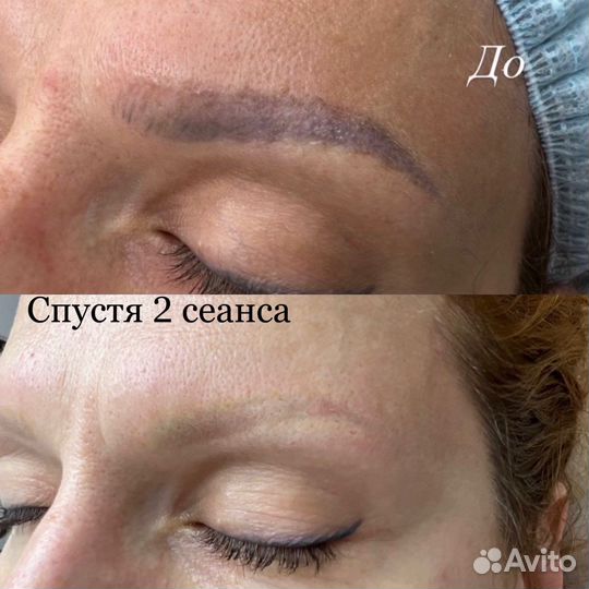 Удаление татуажа, тату, пилинг, лазерная эпиляция