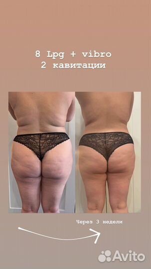 Lpg. Вибро, Вакуум. Кавитация. Массаж лица