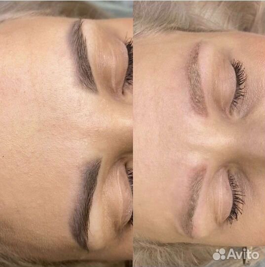 Лазерное удаление тату