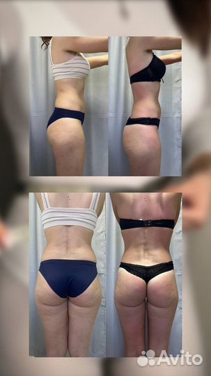 Lpg массаж, ручной массаж, кавитация, вибромассаж