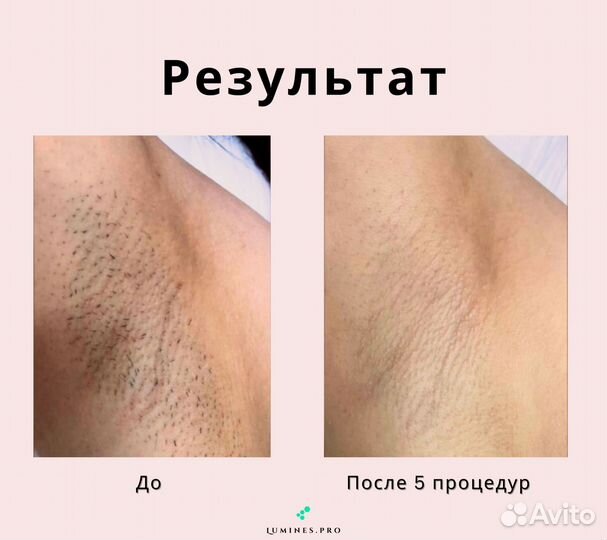 Диодный лазер для эпиляции Люминес. максван 1200