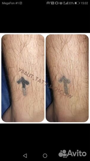 Удаление тату,Татуаж,пилинг,удалить татуировку