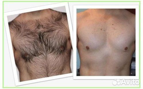 Обучение депиляции