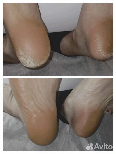 Подолог, педикюр. Выезд на дом по Приморскому р-ну