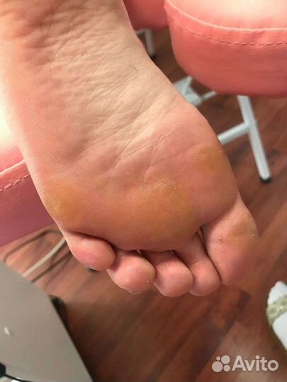 Аппаратный педикюр